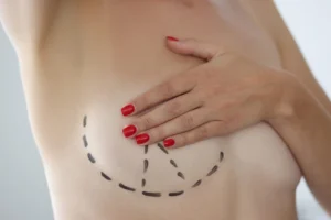¿Cómo mejorar las cicatrices de mastopexia?