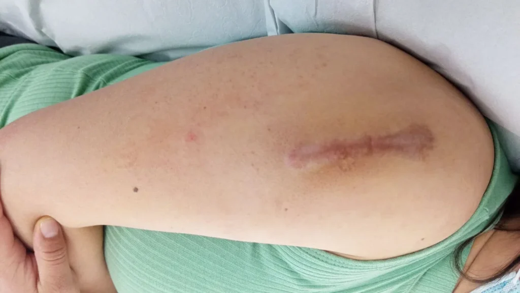 Cómo Quitar Cicatrices Antiguas y Reducir Marcas en la Piel