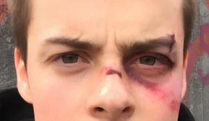 Heridas en la Cara: Tratamientos y Cuidados