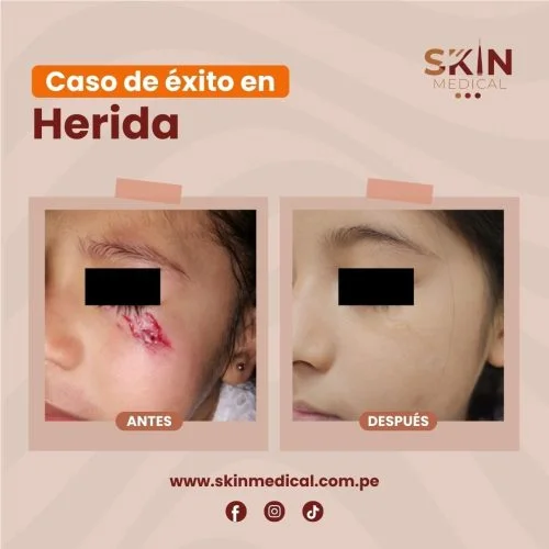 herida profunda abierta