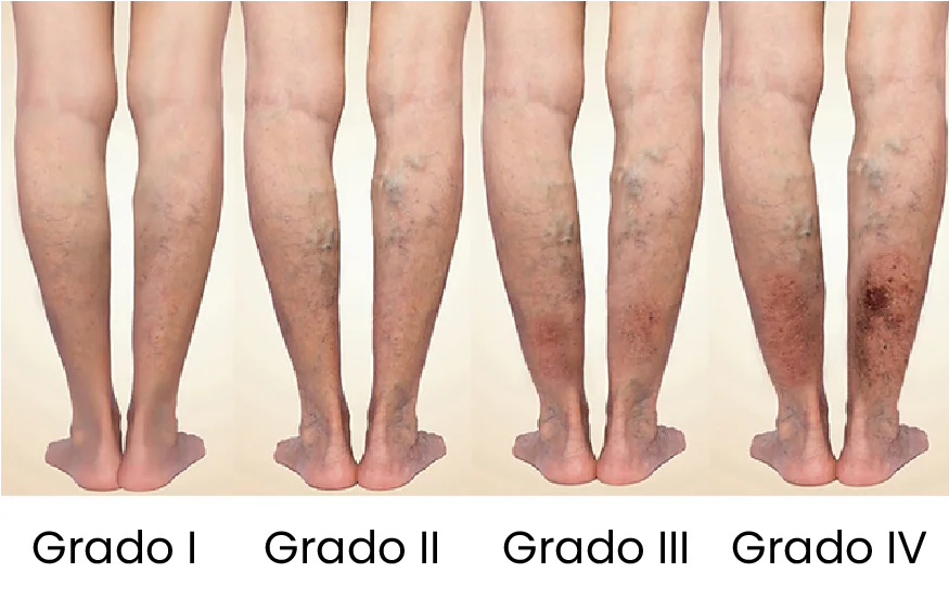 úlceras varicosas