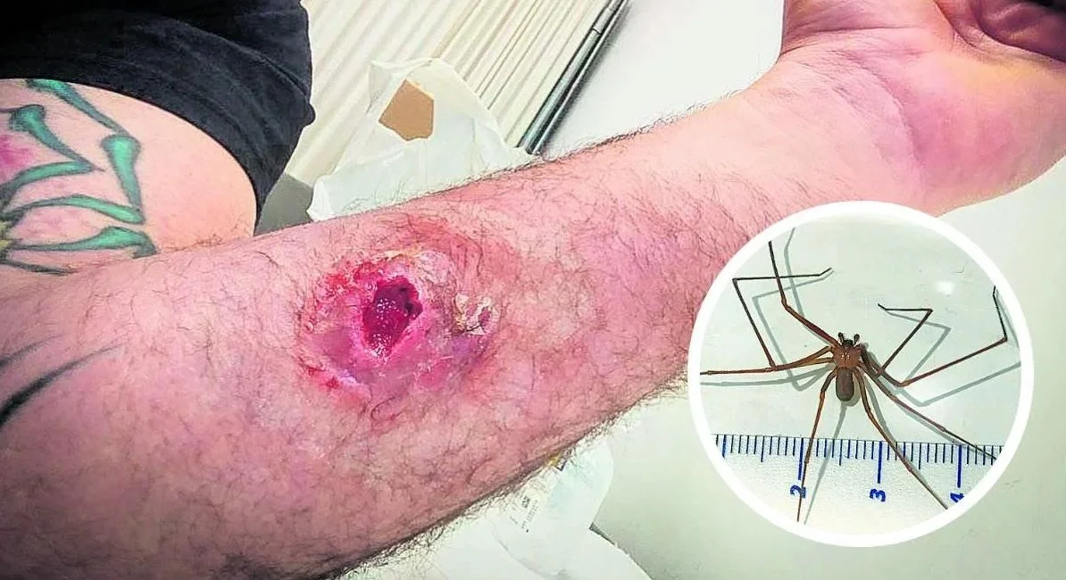 Cómo curar picadura o mordedura de araña infectada