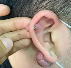Cómo Quitar Queloides de Piercing y Mejorar la Piel