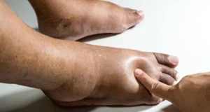 Factores de Riesgo del Pie Diabético y Cómo Prevenirlo