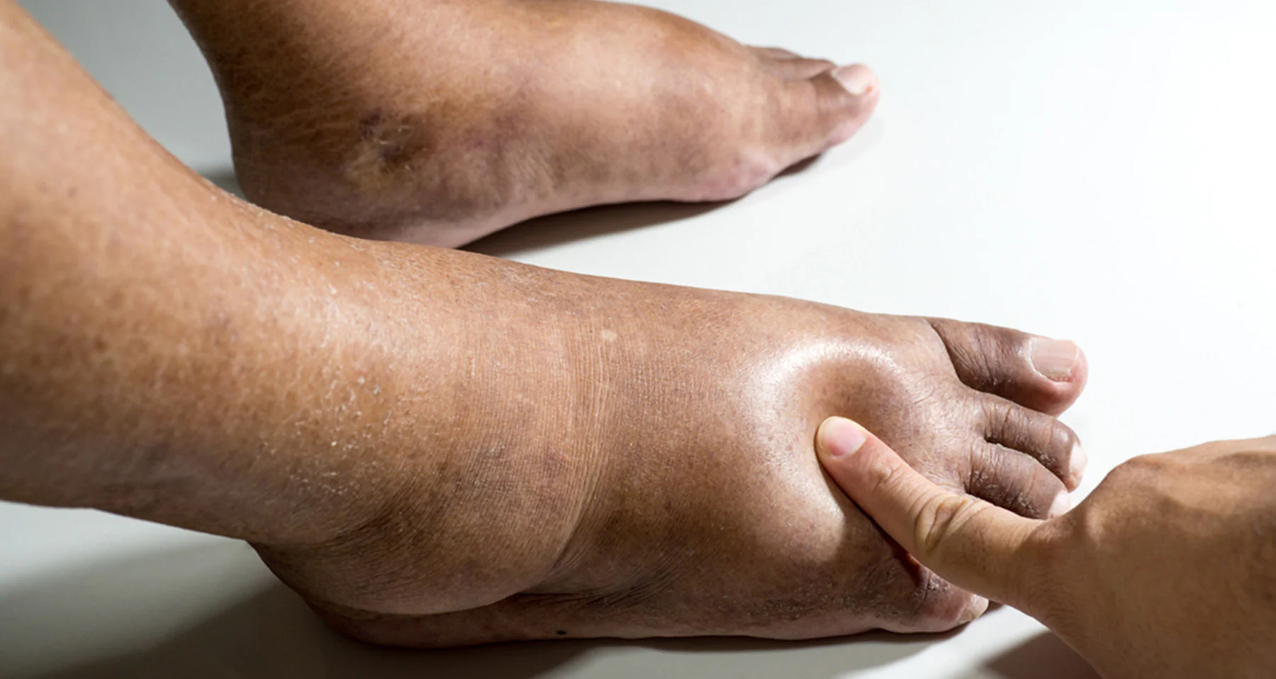 Factores de riesgo asociados a pie diabético​