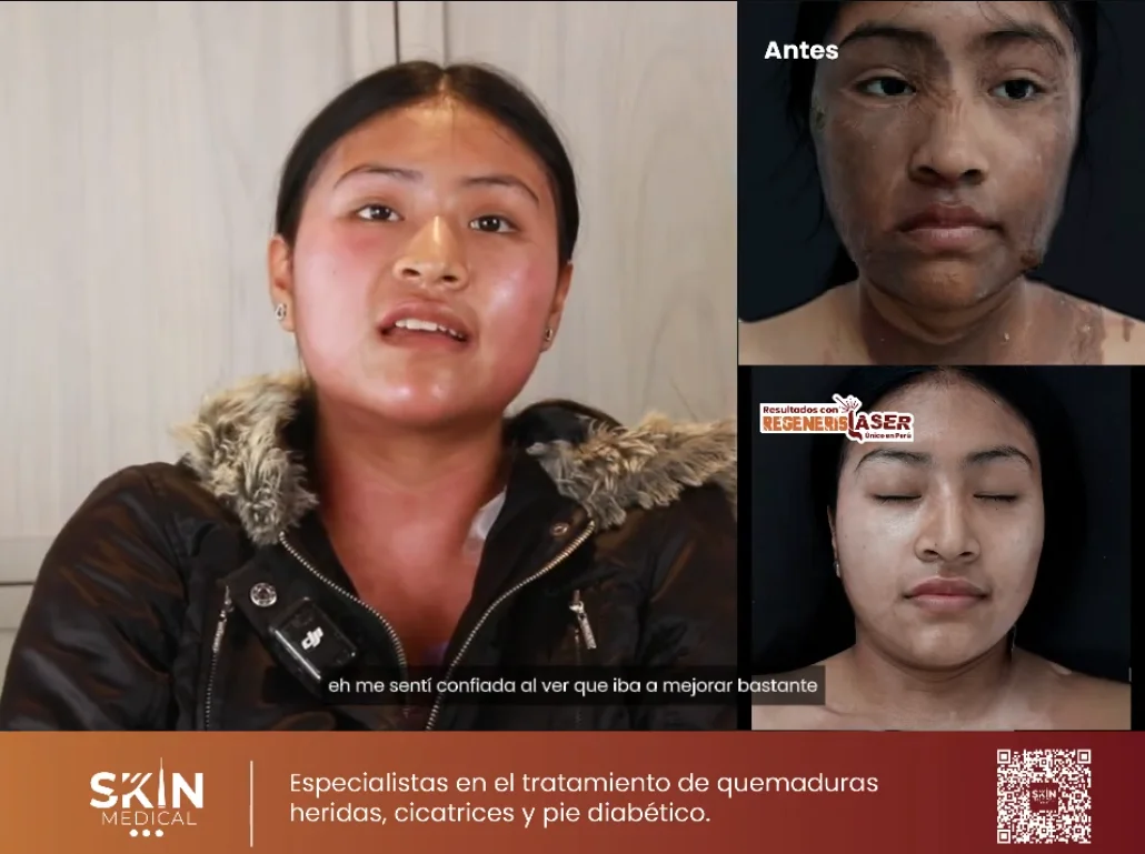 Quemaduras: Historias de recuperación con nuestro tratamiento láser RegenerisLaser