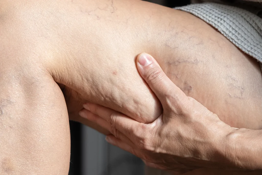 úlceras varicosas . Pierana con várices y arañas vasculares. Una mano presiona la piel, mostrando las venas afectadas.