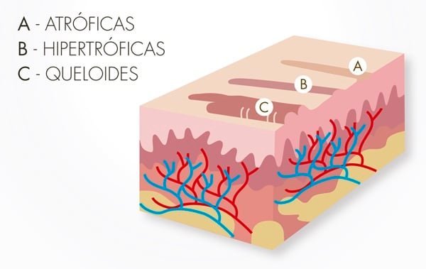 Cicatriz, diferencias entre normales, hipertrófica y queloide
