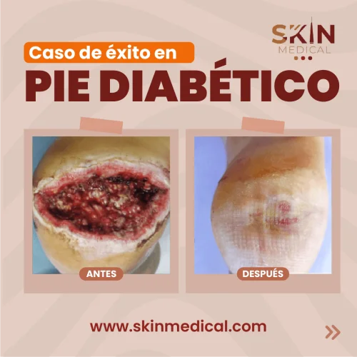 Caso de éxito en pie diabético con úlcera plantar profunda antes y después de tratamiento de curación avanzada en Skin Medical