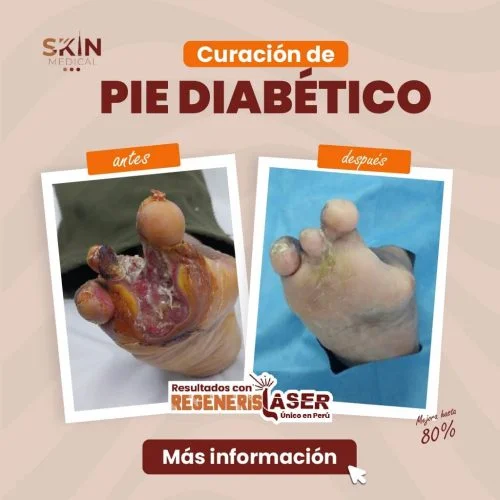 Antes y después de curación de pie diabético severo con láser Regeneris para regeneración cutánea avanzada