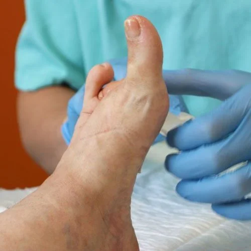 Profesional médico con guantes evaluando pie diabético para prevención y curación avanzada de heridas