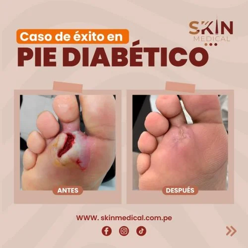 tratamiento de pie diabético