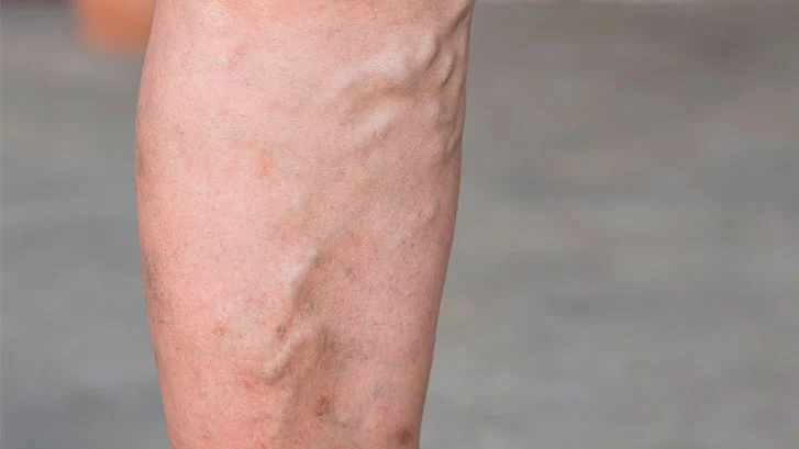 Úlceras varicosas . Pierna con várices abultadas, un signo claro de insuficiencia venosa que requiere tratamiento.