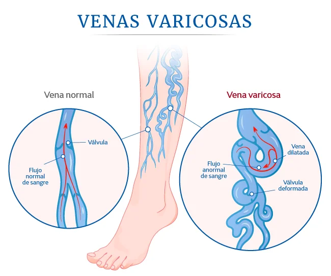 Diagrama: vena normal con flujo sanguíneo y válvulas funcionales versus vena varicosa dilatada con válvulas deformadas y flujo anormal.