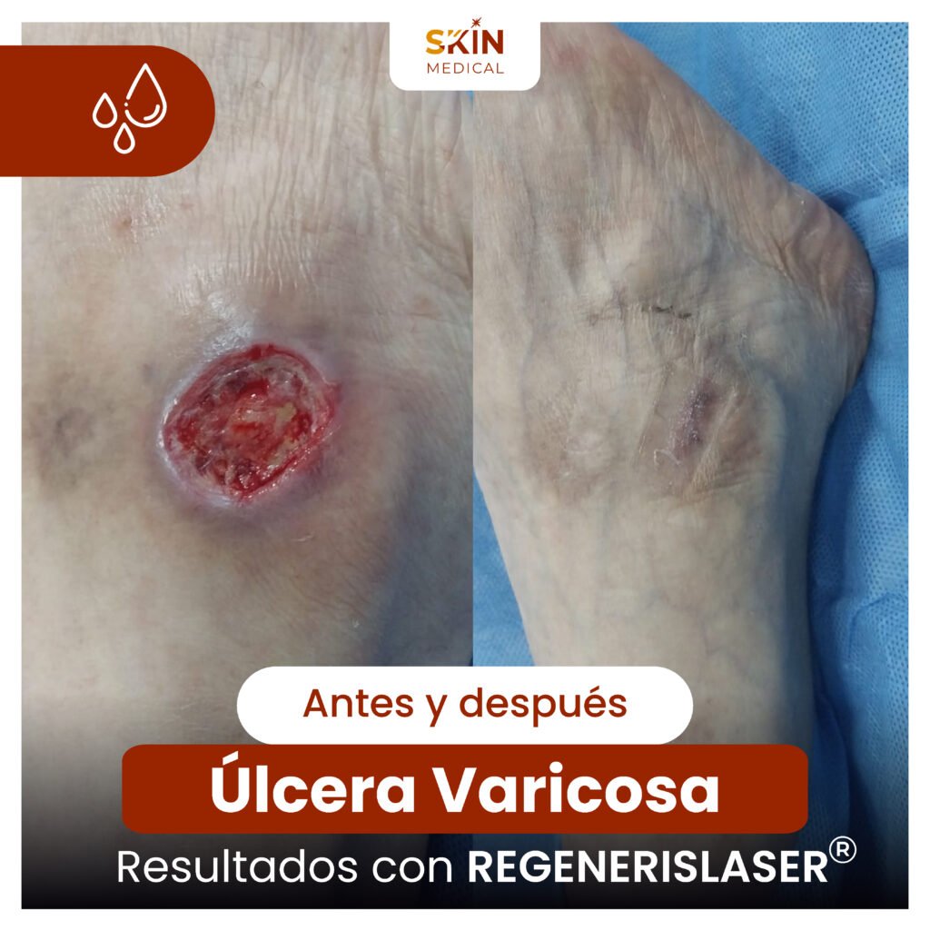 Antes y despues de un tratamiento para úlcera varicosa