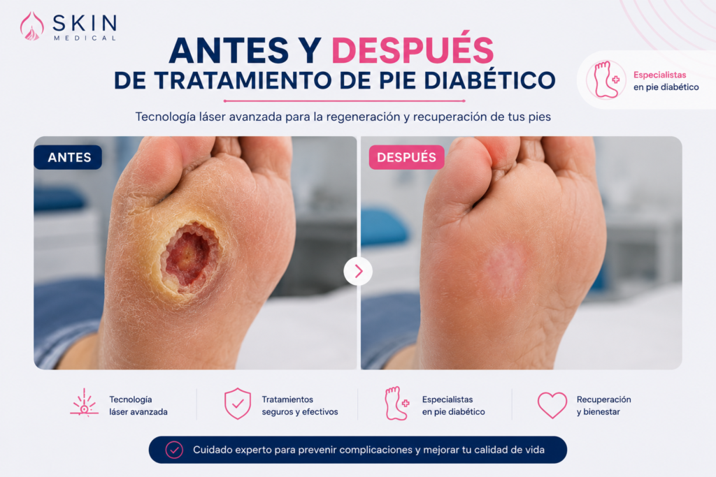 Antes y después de tratamiento de pie diabético en Skin Medical