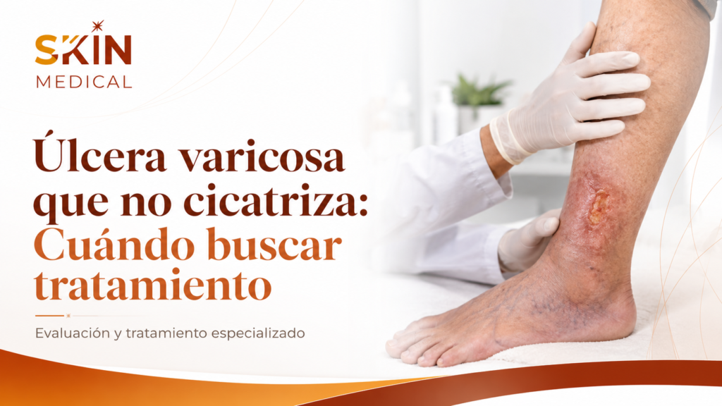 Úlcera varicosa que no cicatriza: Cuándo buscar tratamiento