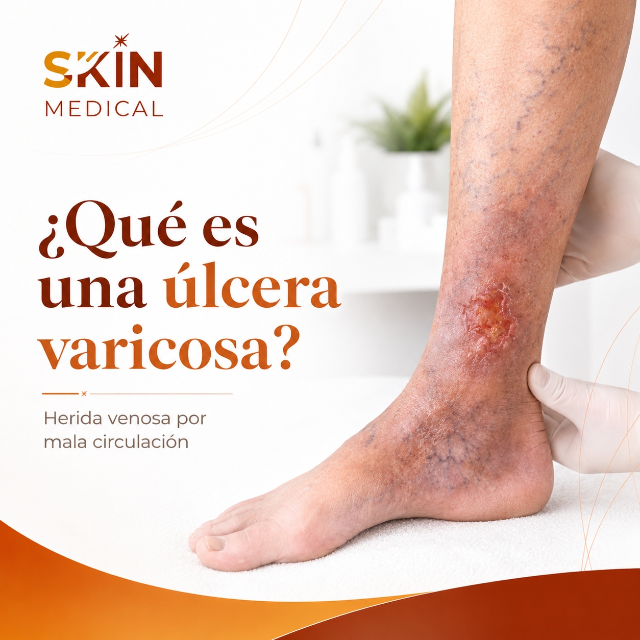 ¿Qué es una úlcera varicosa?
