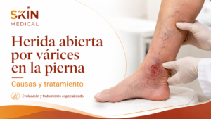 Herida abierta por várices en la pierna: Causas y tratamiento