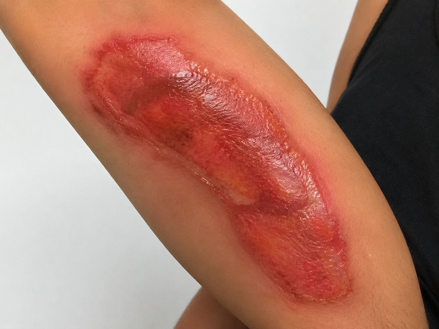 Quemadura en brazo antes