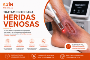Tratamiento para Heridas Venosas