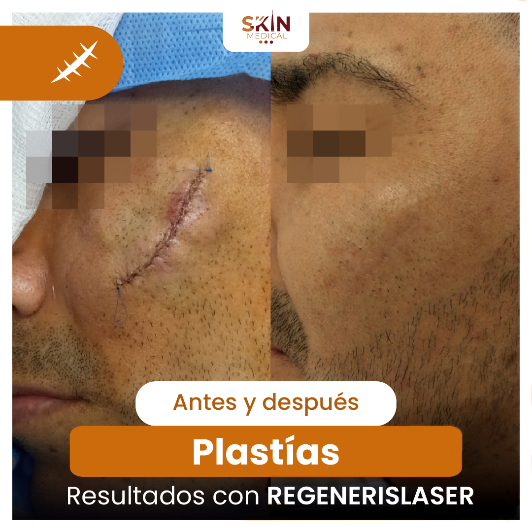 Tercer caso de cicatriz antes y después