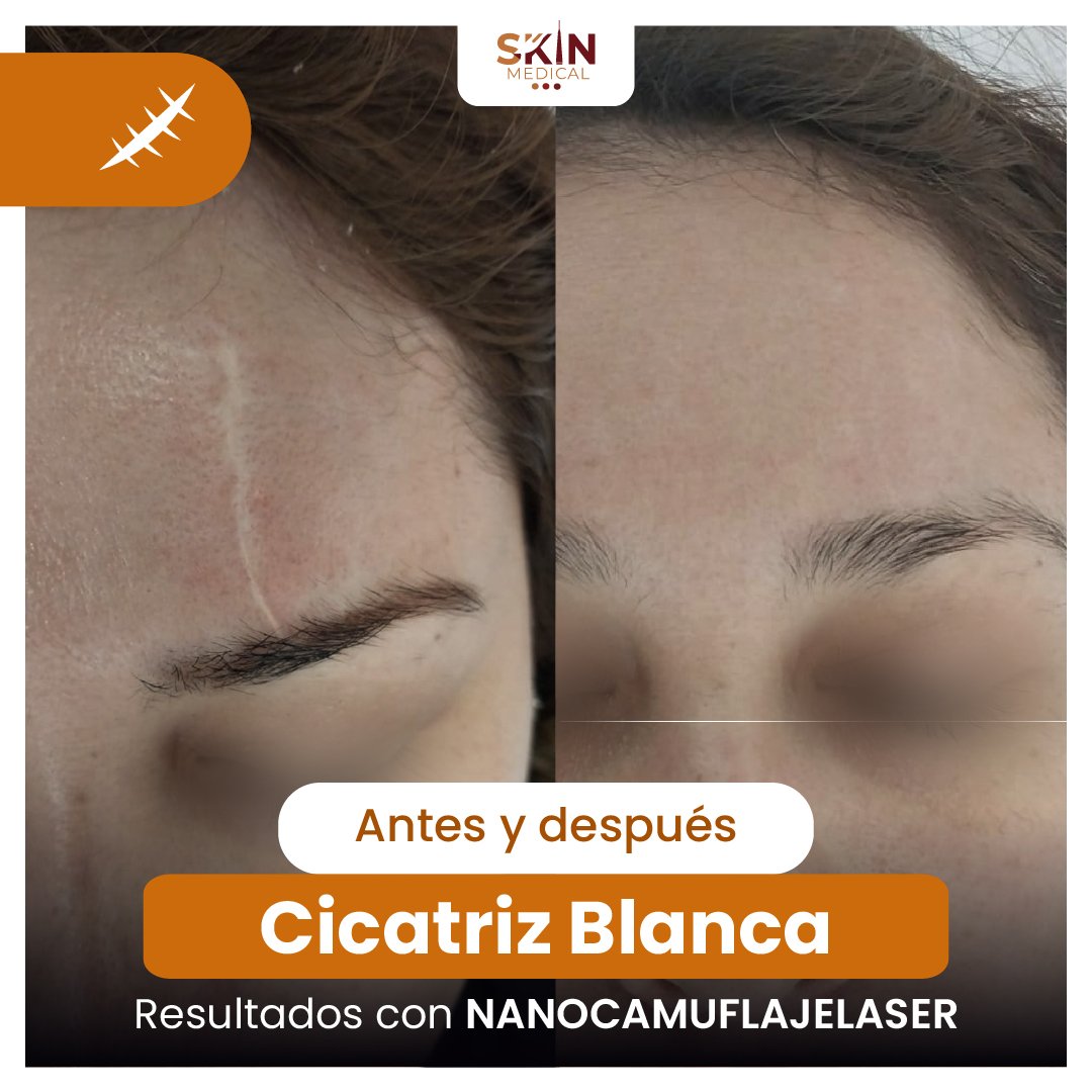 Primer caso de cicatriz antes y después