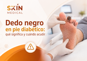 Dedo negro en pie diabético: qué significa y cuándo acudir