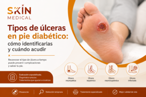 Tipos de úlceras en pie diabético: cómo identificarlas y cuándo acudir