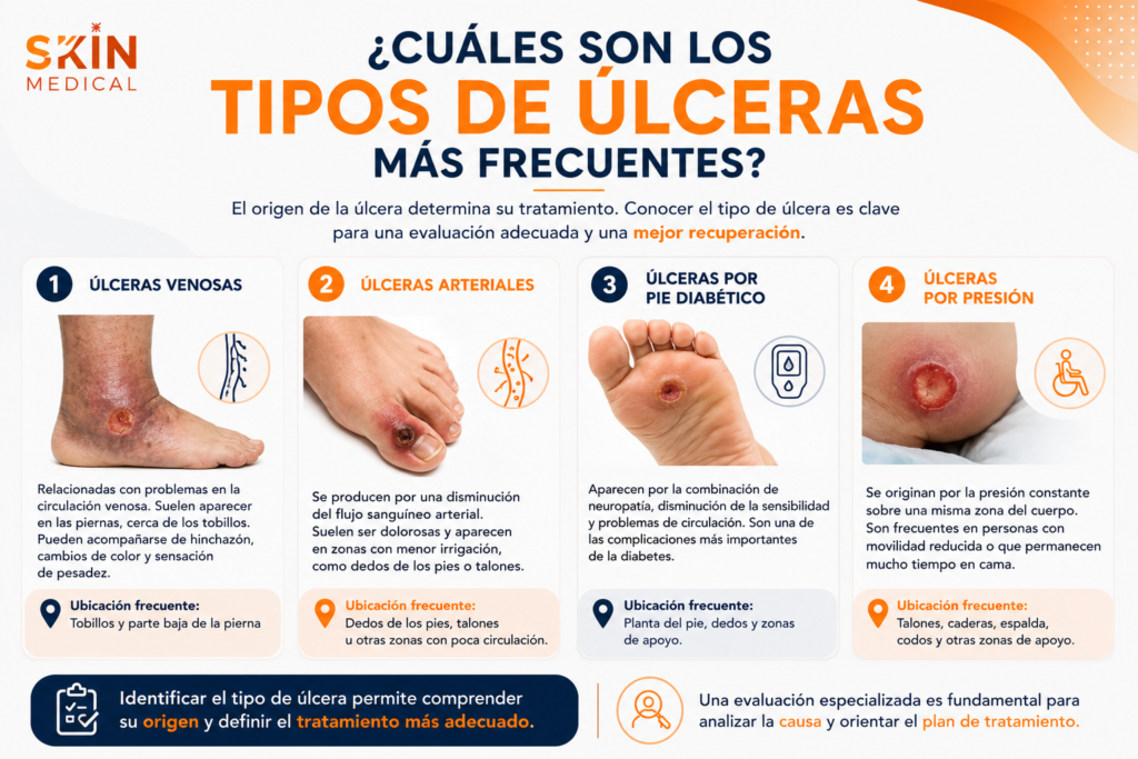 ¿Cuáles son los tipos de úlceras más frecuentes?