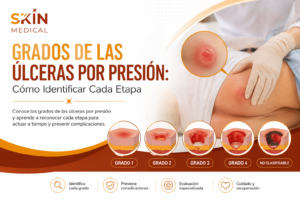 Grados de las Úlceras por Presión: Cómo Identificar Cada Etapa