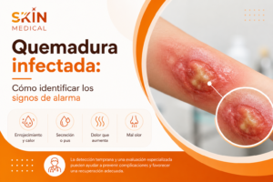 Quemadura infectada: Cómo identificar los signos de alarma