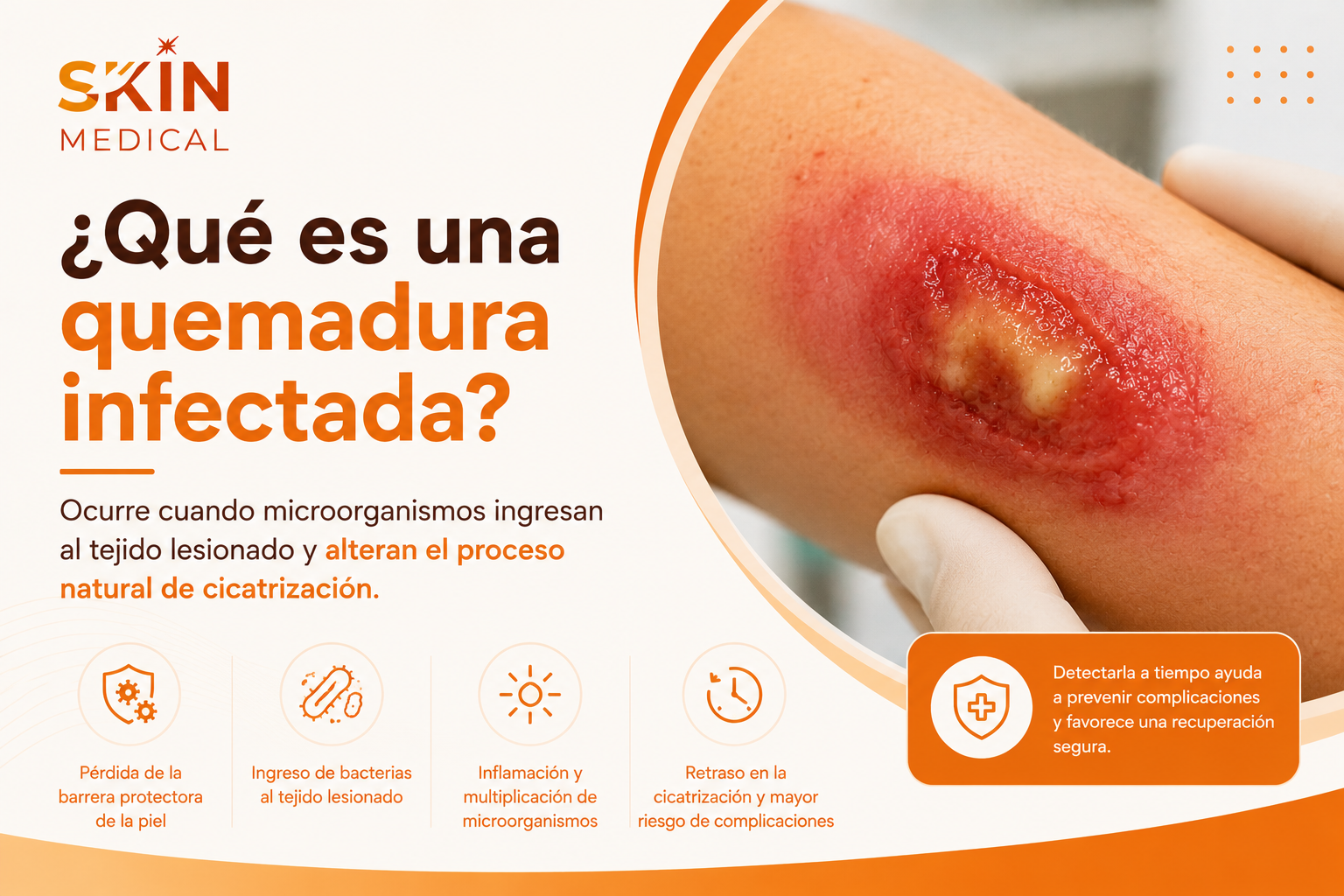 ¿Qué es una quemadura infectada?​