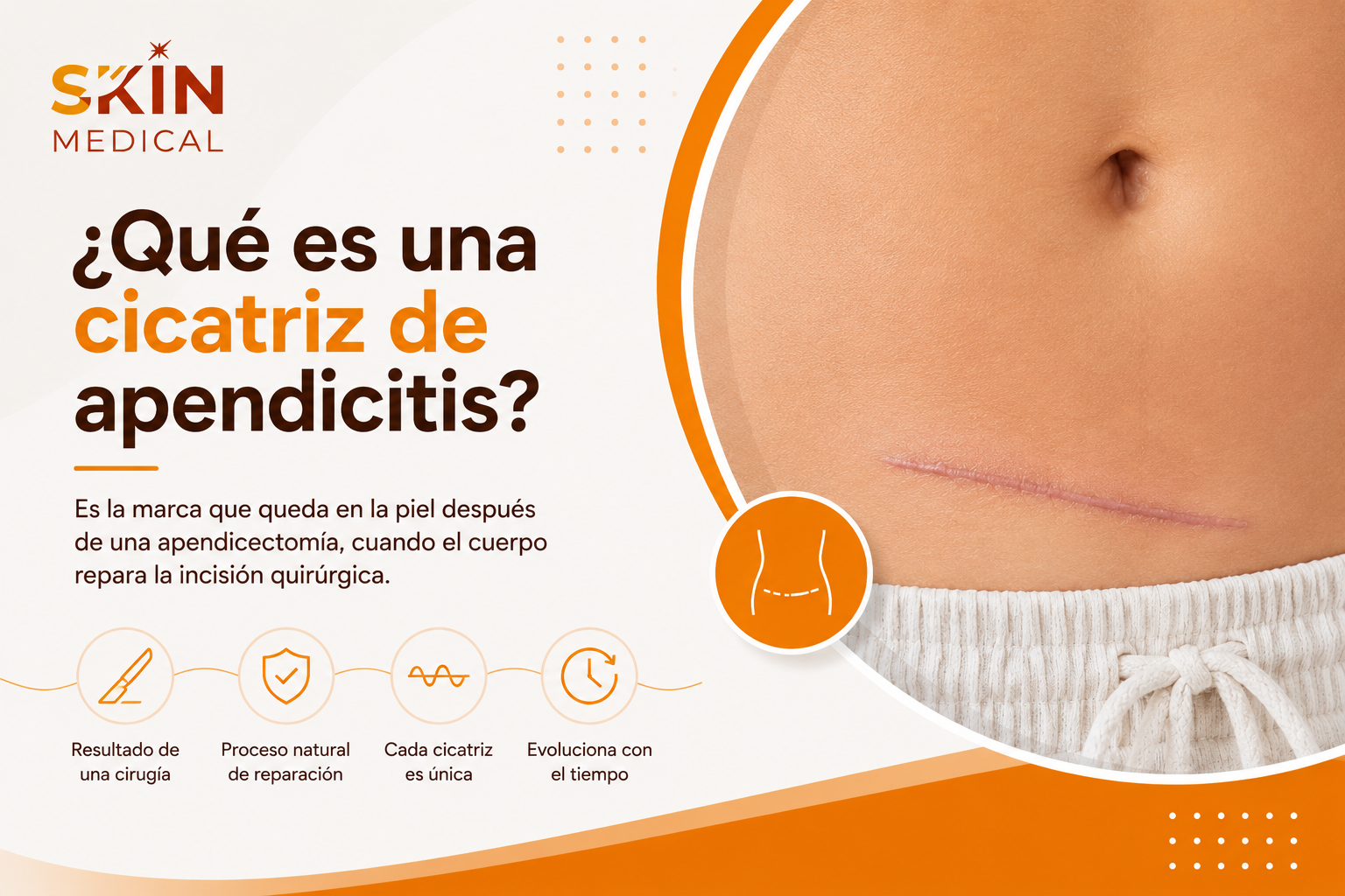 ¿Qué es una cicatriz de apendicitis?