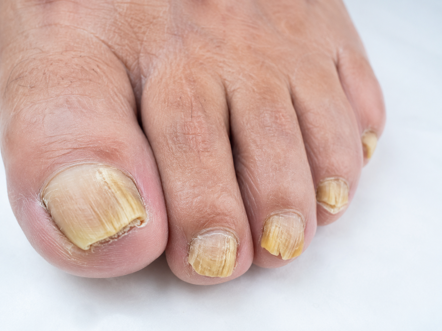 Uñas engrosadas en pacientes diabéticos