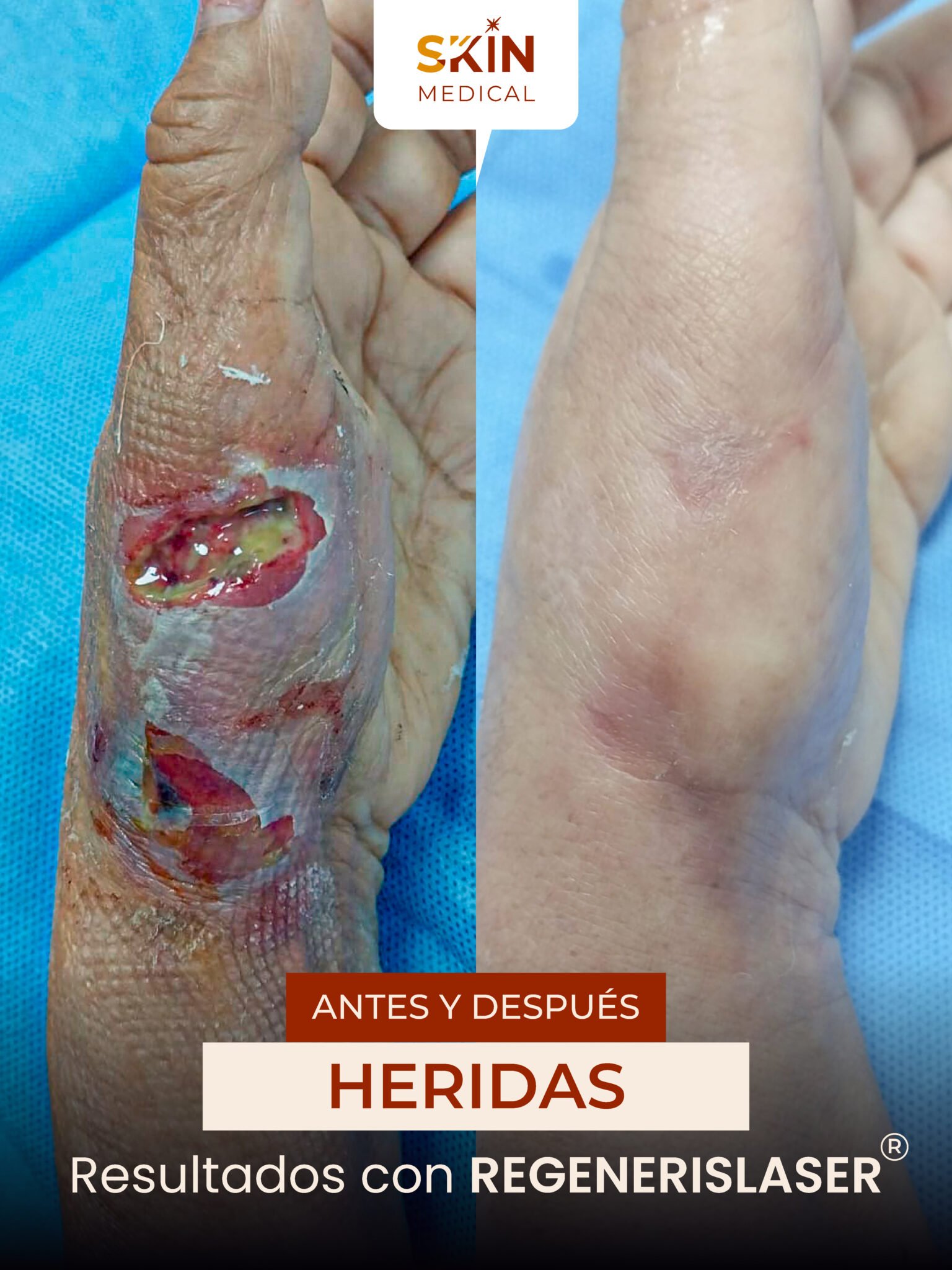 Primer caso de herida antes y después