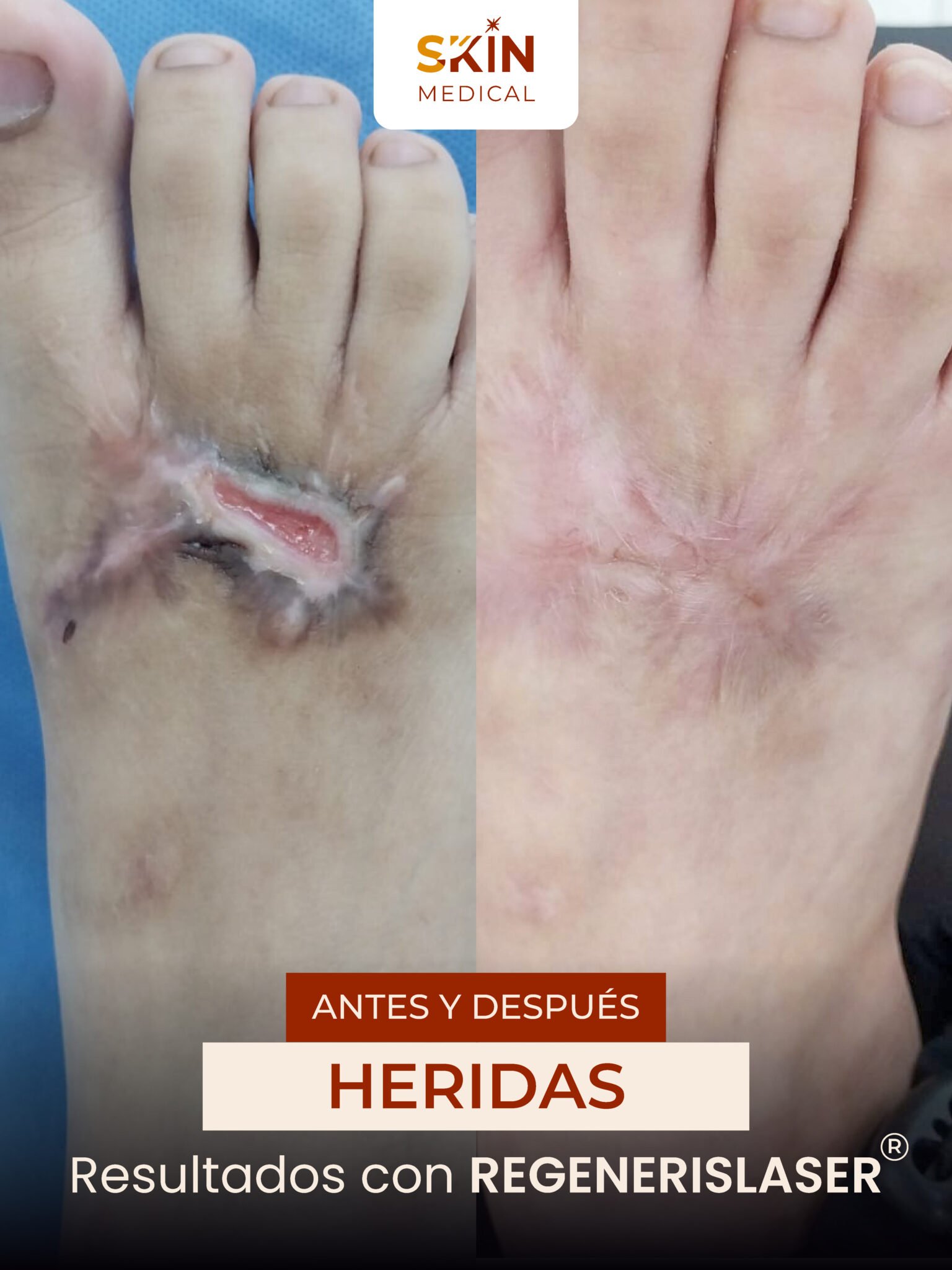 Primer caso de herida antes y después