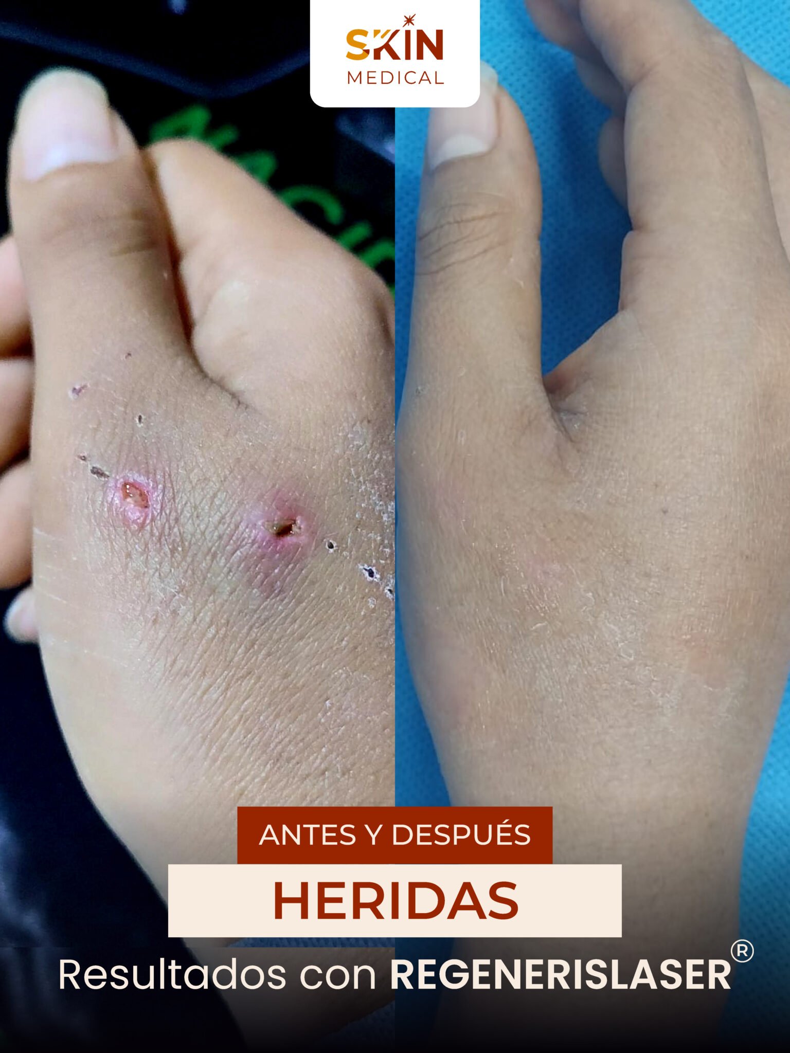 Segundo caso de herida antes y después