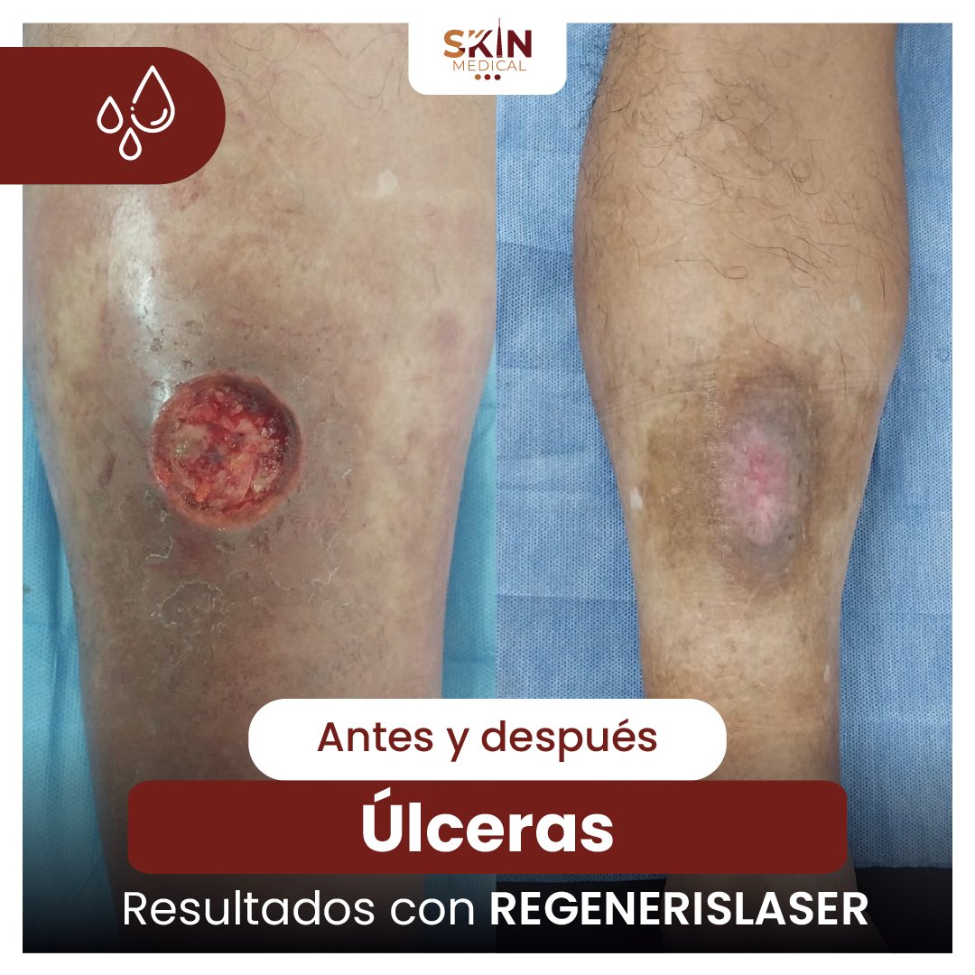 Tercer caso de herida antes y después