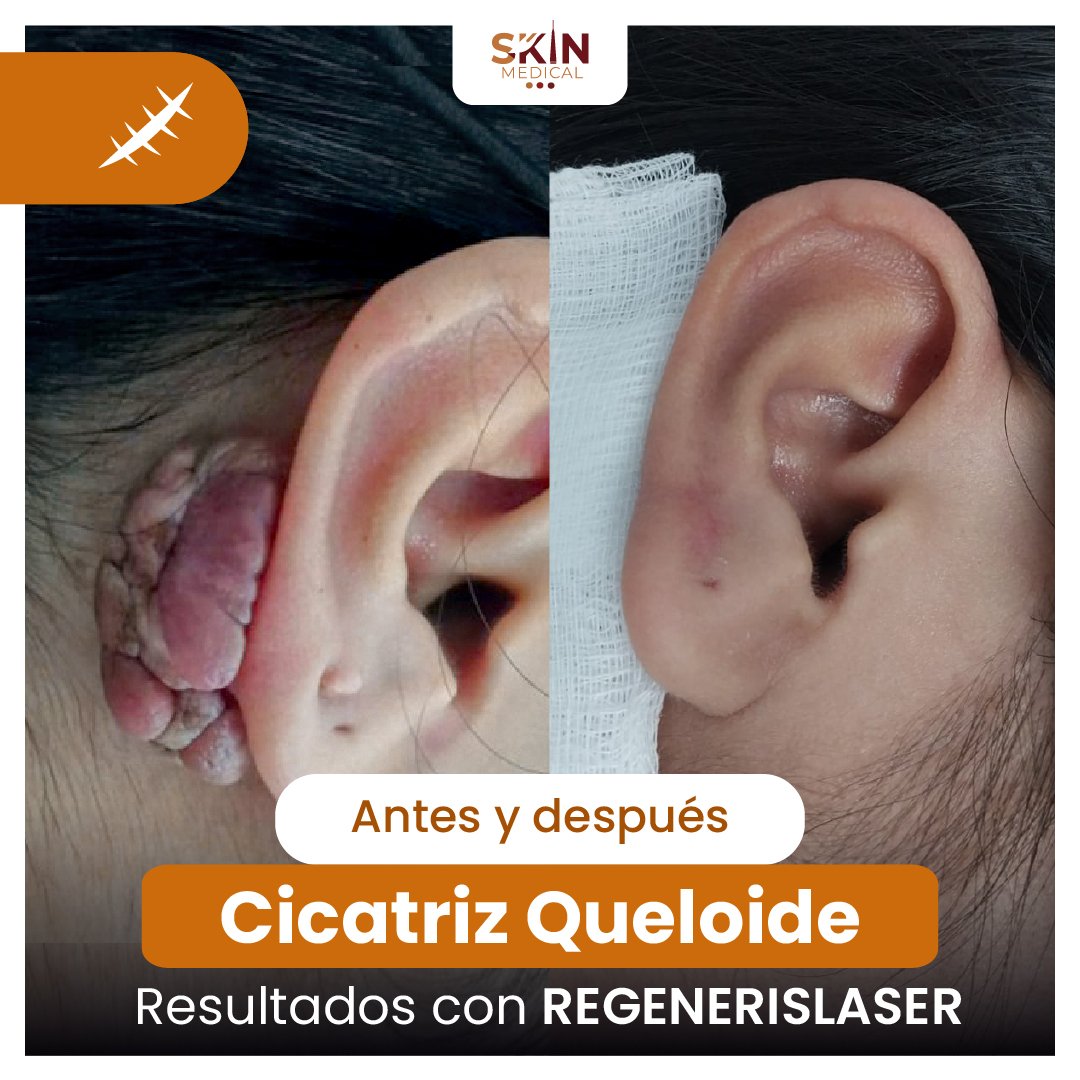 Tercer caso de queloide en la oreja antes y después