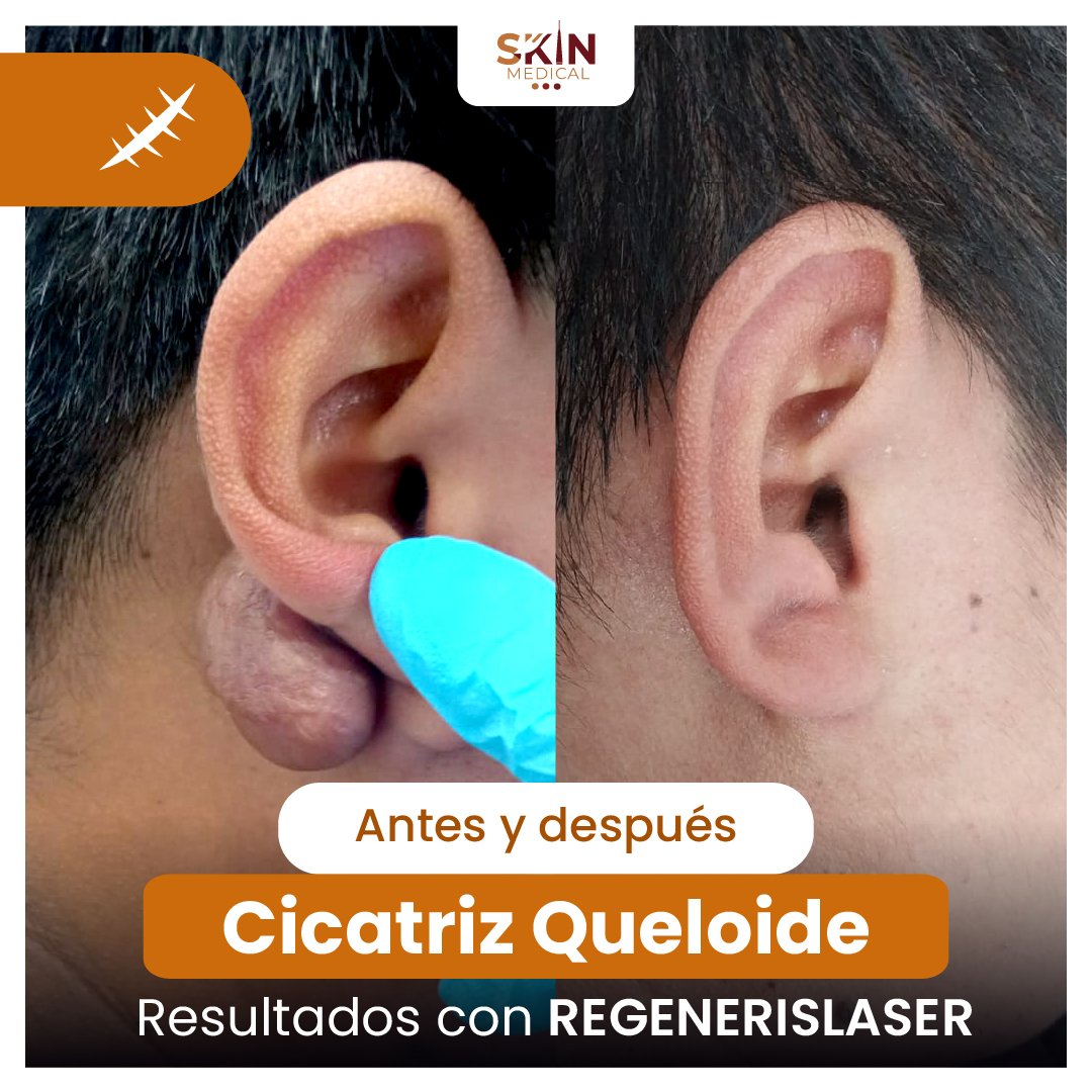 Caso de queloide en la oreja antes y después