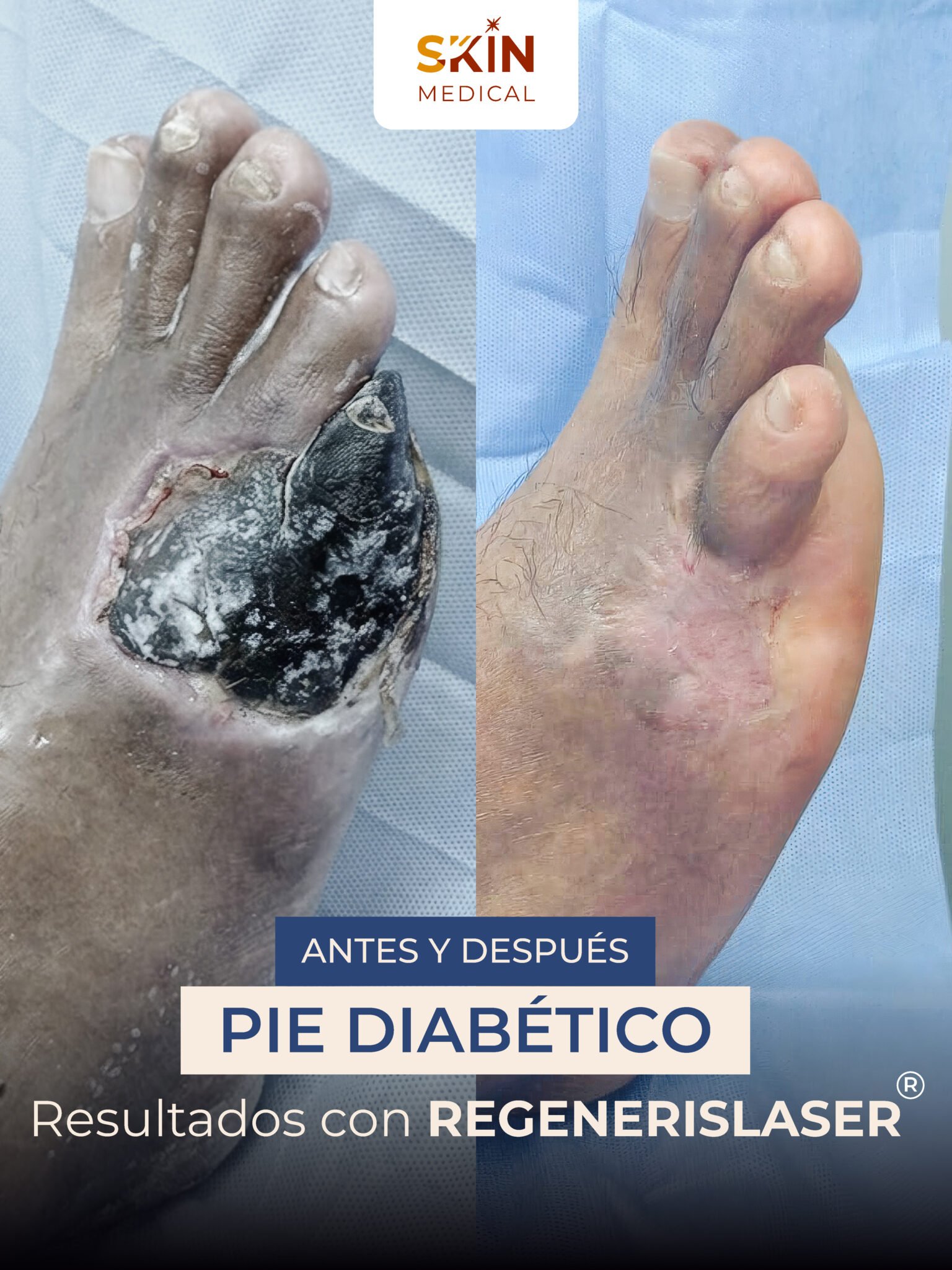 Tercer caso de pie diabético antes y después