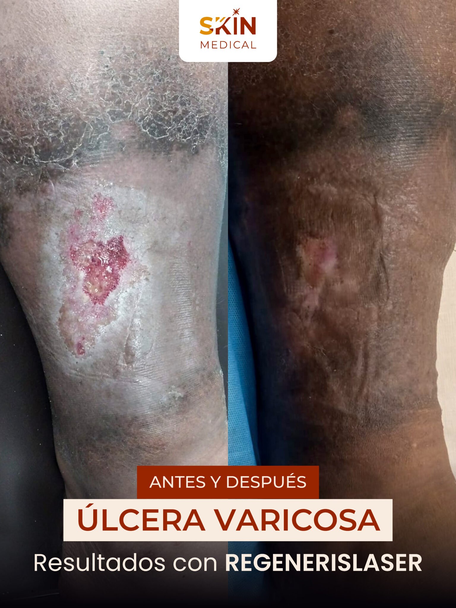 Segundo caso de úlcera varicosa antes y después