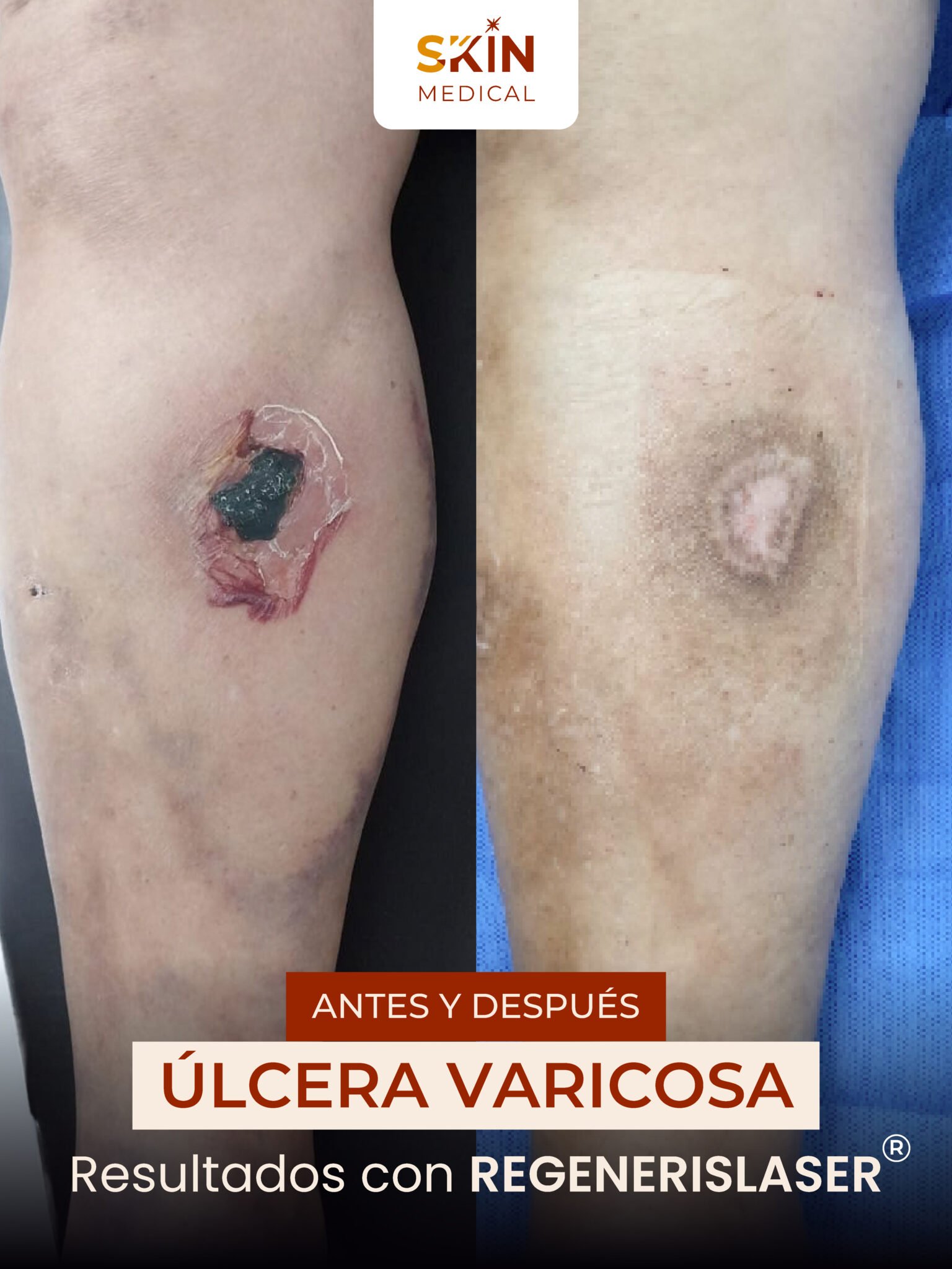 Caso de úlcera varicosa antes y después