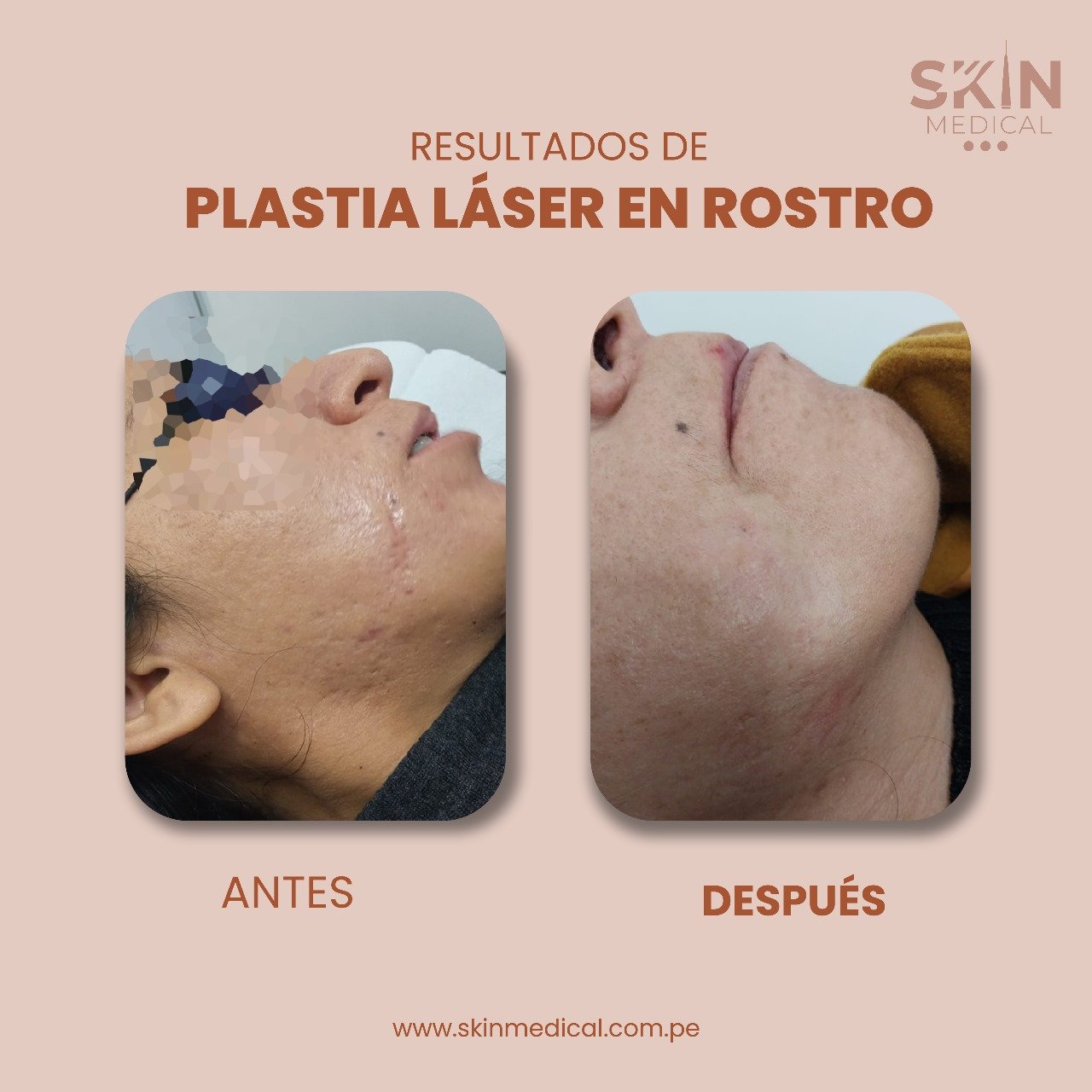 Segundo caso de cicatriz antes y después