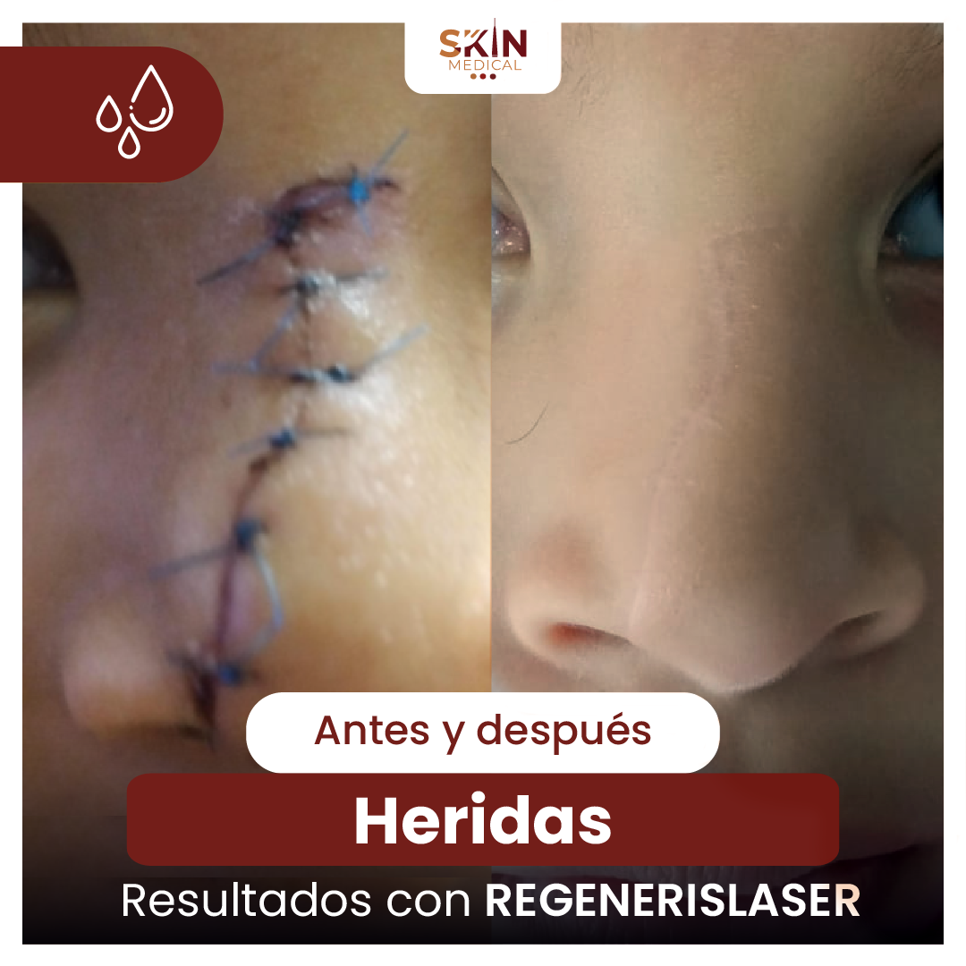 Tercer caso de herida antes y después