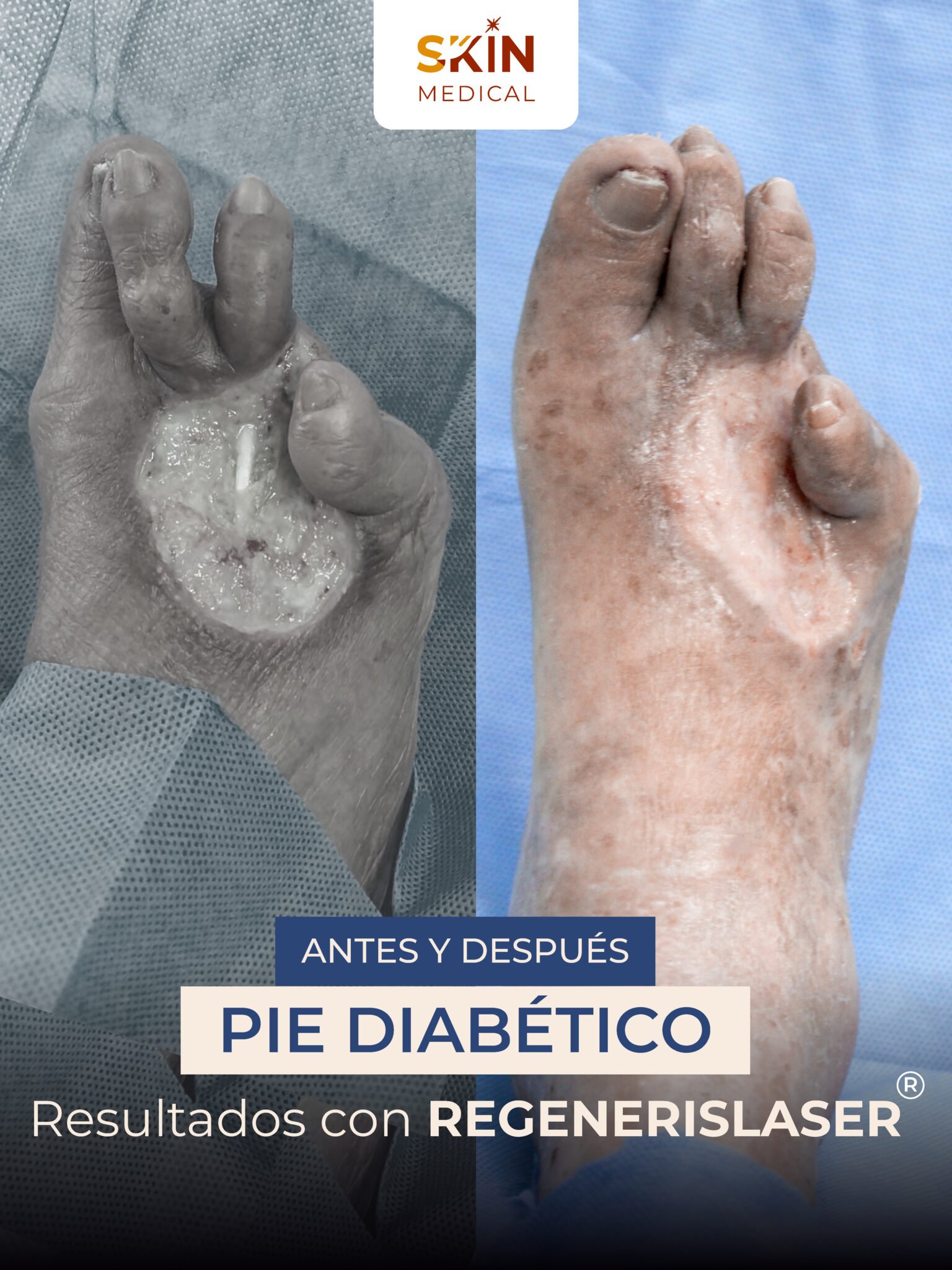 Primer caso de pie diabético antes y después