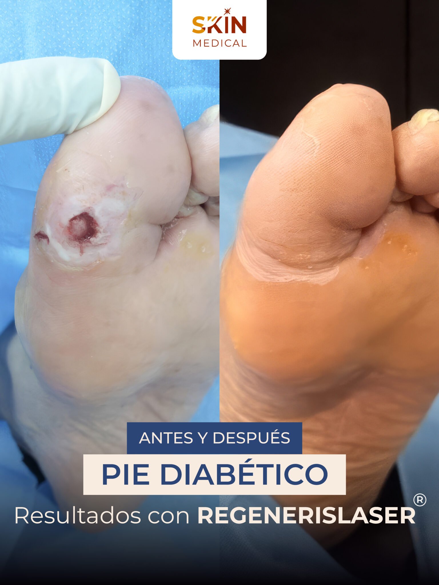 Segundo caso de pie diabético antes y después