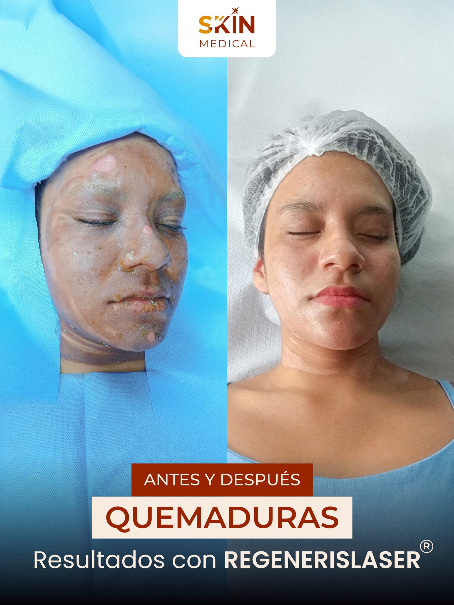 Segundo caso de quemadura antes y después