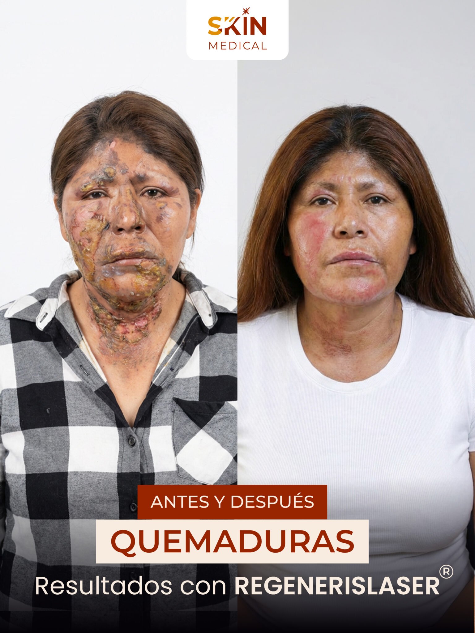 Primer caso de quemadura antes y después